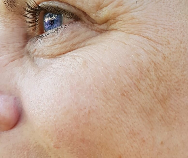 best way to treat under eye wrinkles