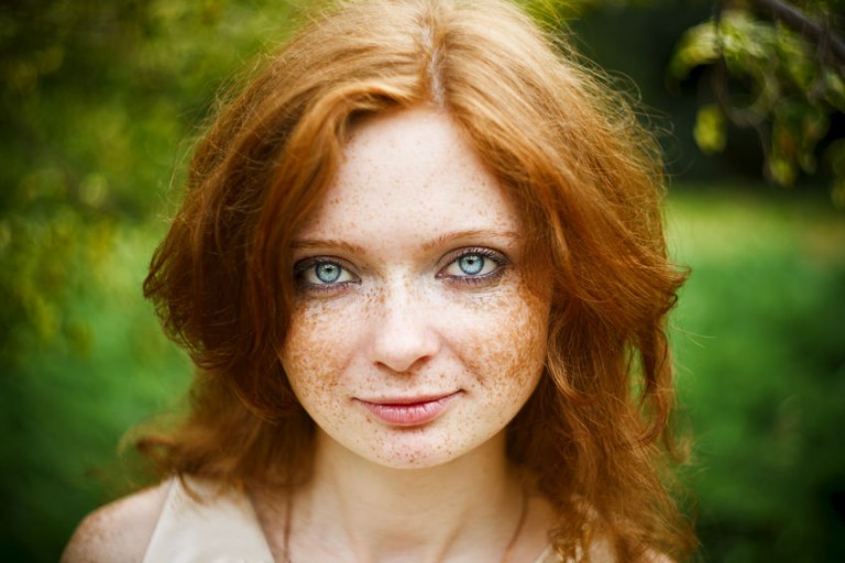 facts about freckles
