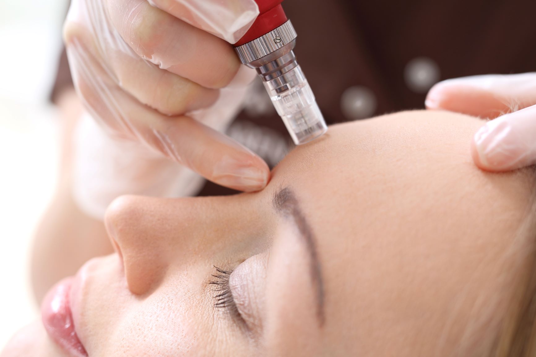 micro needling for acne scars