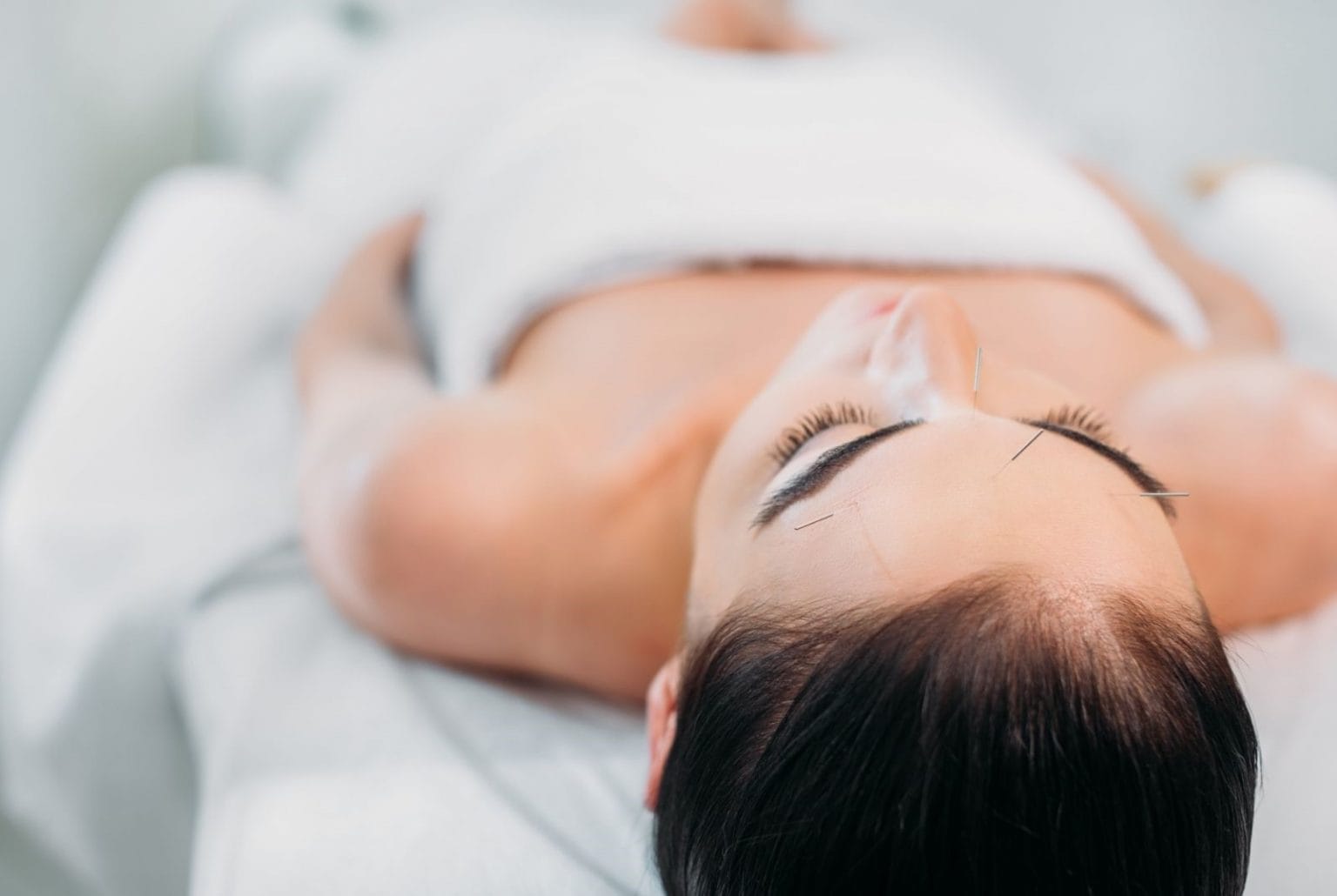 How Acupuncture for Wrinkles is the Latest AntiAging Salvation